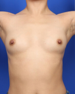 Case # 94 before photo