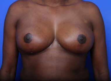 Case # 15 after photo