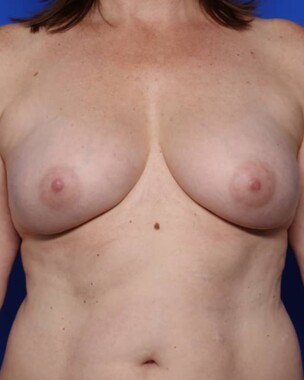 Case # 13 after photo