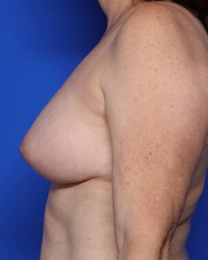 Case # 13 after photo