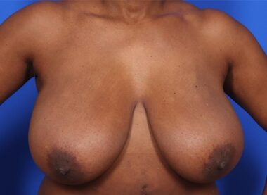 Case # 32 before photo