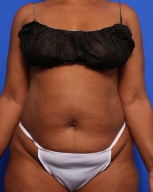 Case # 17 before photo