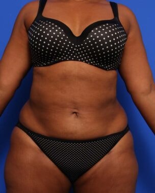 Case # 17 after photo