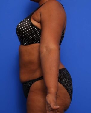 Case # 17 after photo