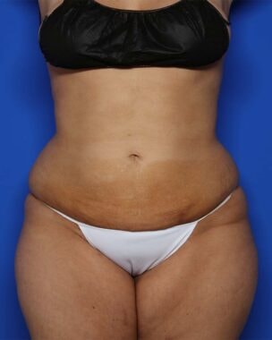 Case # 1 after photo