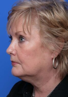 Case # 18 before photo