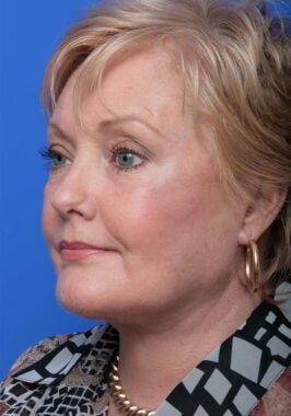 Case # 18 after photo