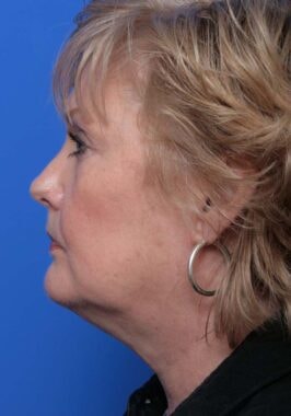 Case # 18 before photo