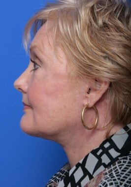 Case # 18 after photo