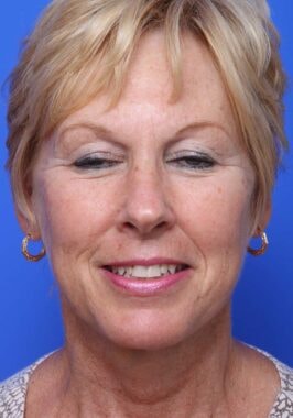 Case # 19 after photo