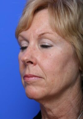 Case # 19 before photo