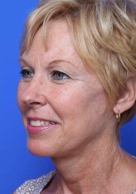 Case # 19 after photo