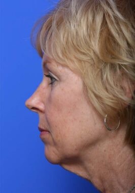 Case # 19 before photo