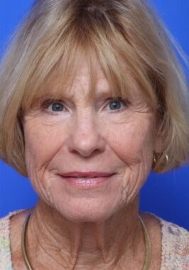 Case # 20 before photo