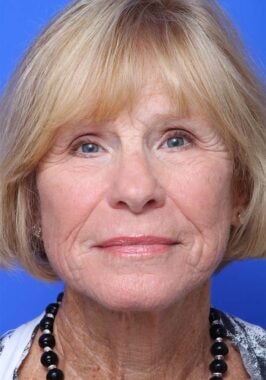 Case # 20 after photo