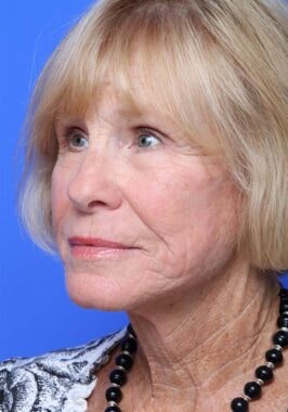 Case # 20 after photo