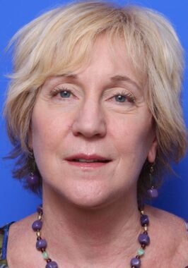 Case # 21 after photo