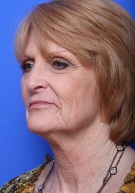 Case # 22 before photo