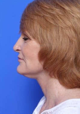 Case # 22 after photo