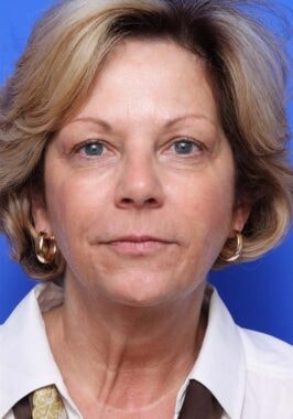 Case # 23 before photo