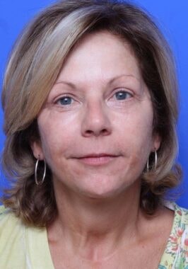 Case # 23 after photo