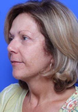 Case # 23 after photo