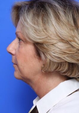 Case # 23 before photo