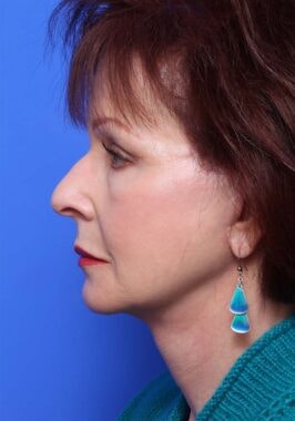 Case # 24 after photo