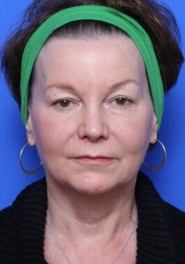 Case # 25 before photo