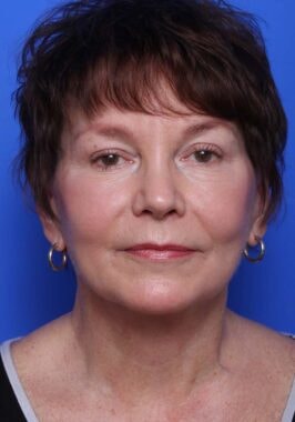 Case # 25 after photo