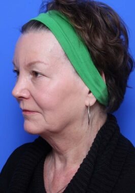 Case # 25 before photo