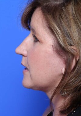 Case # 36 after photo