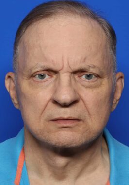 Case # 26 after photo