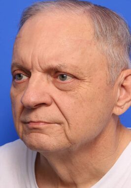 Case # 26 before photo