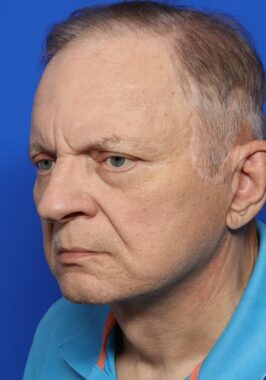 Case # 26 after photo