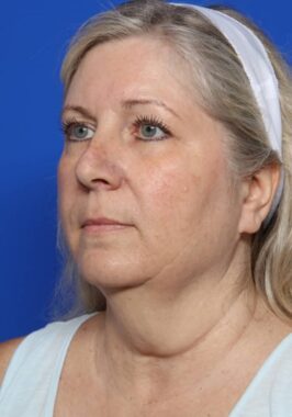 Case # 27 before photo