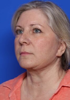 Case # 27 after photo