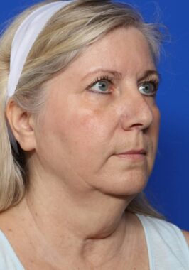 Case # 27 before photo