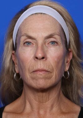 Case # 28 before photo