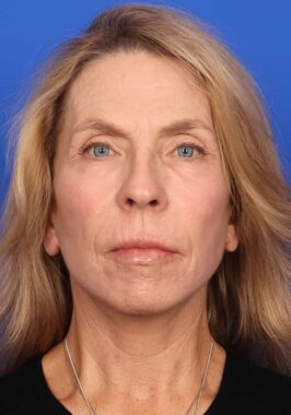 Case # 28 after photo