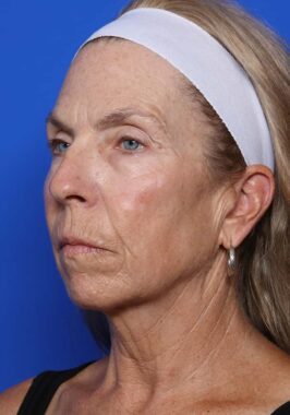 Case # 28 before photo