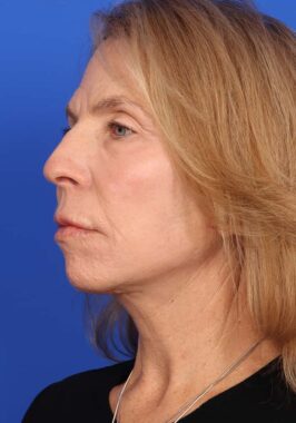 Case # 28 after photo