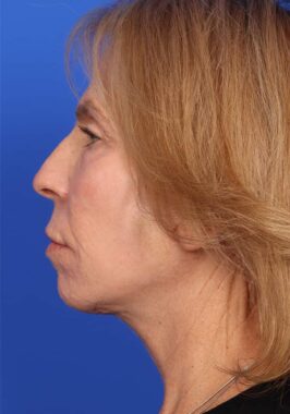 Case # 28 before photo