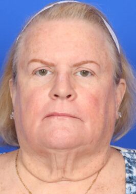 Case # 29 before photo