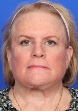 Case # 29 after photo