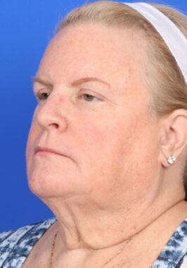 Case # 29 before photo