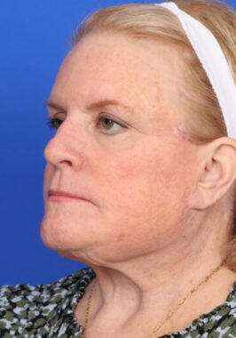 Case # 29 after photo