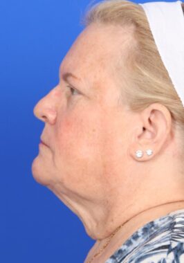 Case # 29 before photo