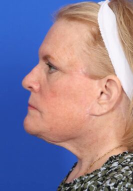 Case # 29 after photo