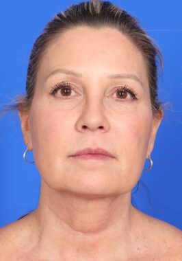 Case # 1 before photo